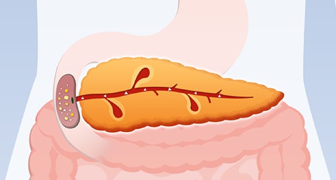 A diagram showing food being processed by the pancreas, where EPI starts