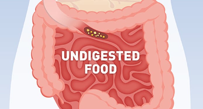 A diagram showing undigested food entering the intestines - this is called maldigestion and can be caused by EPI