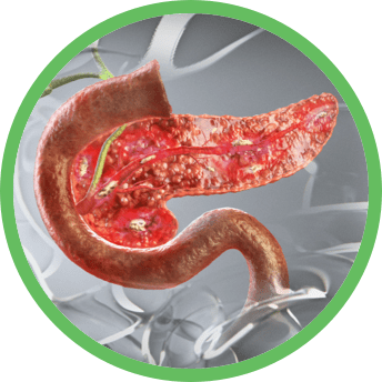 Image conveying decreased production of pancreatic enzymes in pancreas