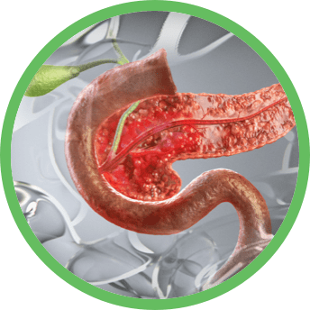 Image of Crohn's disease in pancreas