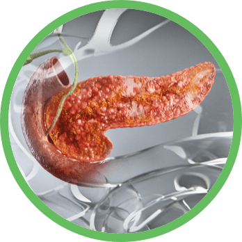 Image of cystic fibrosis (CF) in pancreas